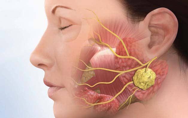 Top Choice for Best Surgeon For Superficial Parotidectomy in India – Safe & Advanced Treatment