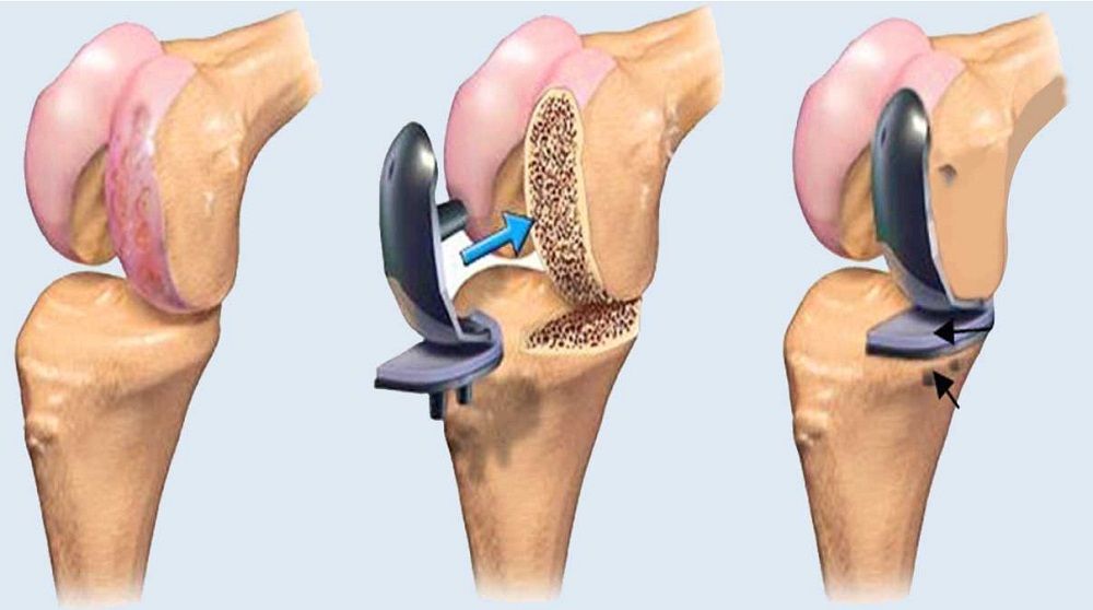 Best Knee Replacement Surgeons in India – Advanced Care with Trusted Experts